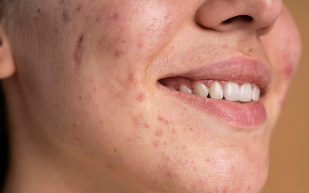 5 pasos de cuidado facial para prevenir el acné